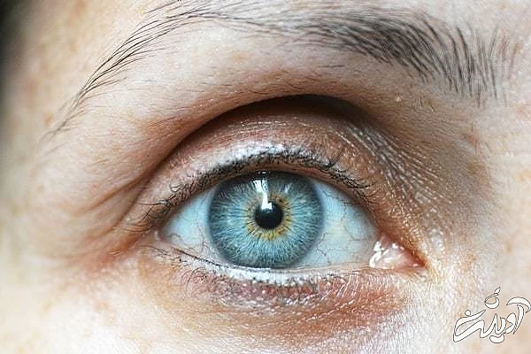 طب سنتی برای تیرگی زیر چشم درمان سیاهی زیر چشم